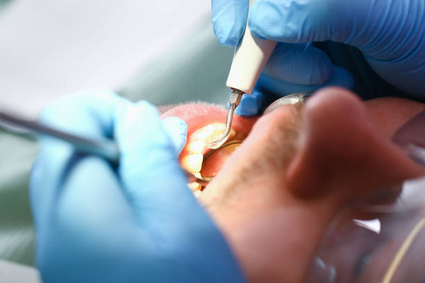 Best Emergency Dental Care for Broken or Chipped Teeth in Pekin, IL
